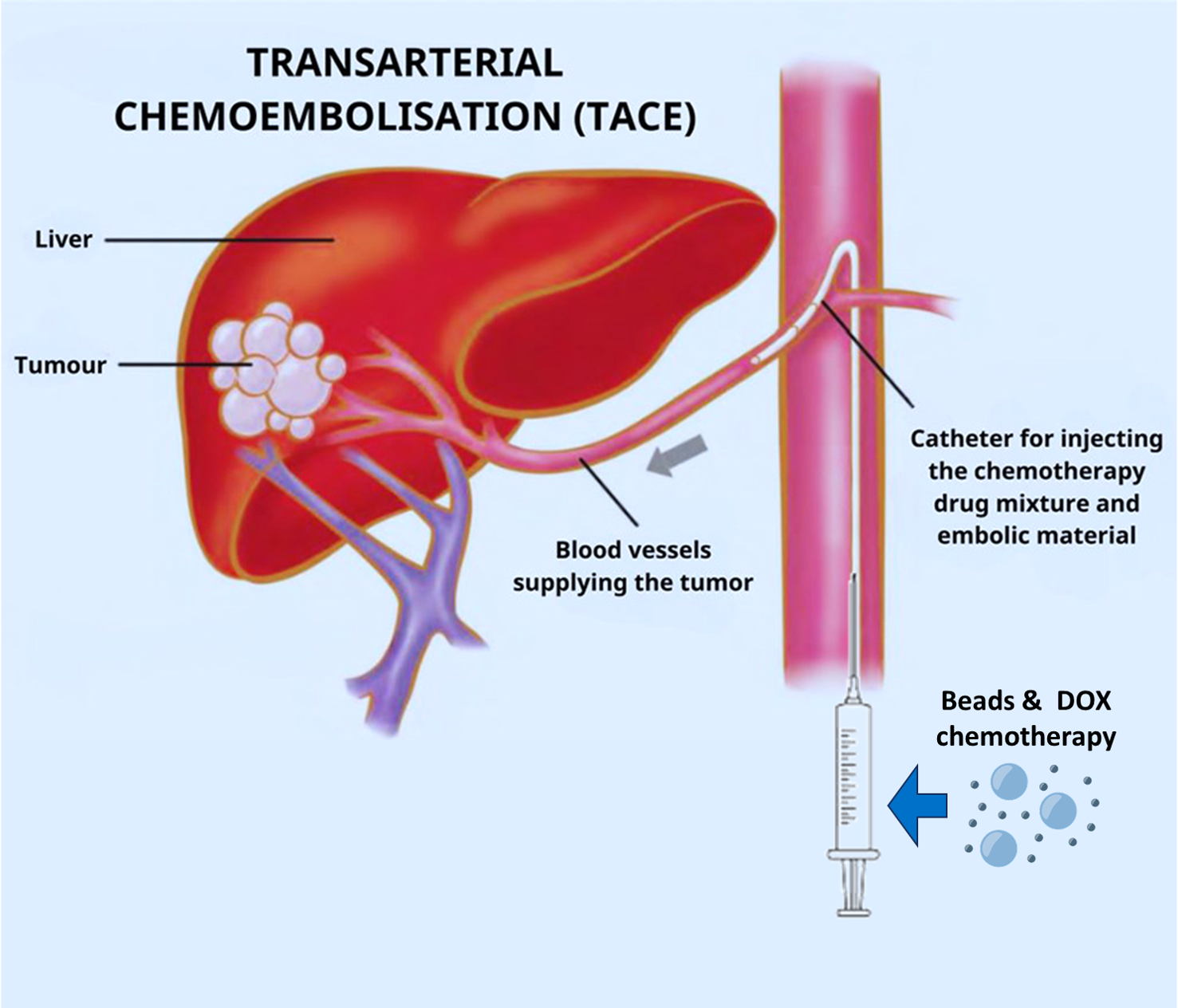 TACE Procedure
